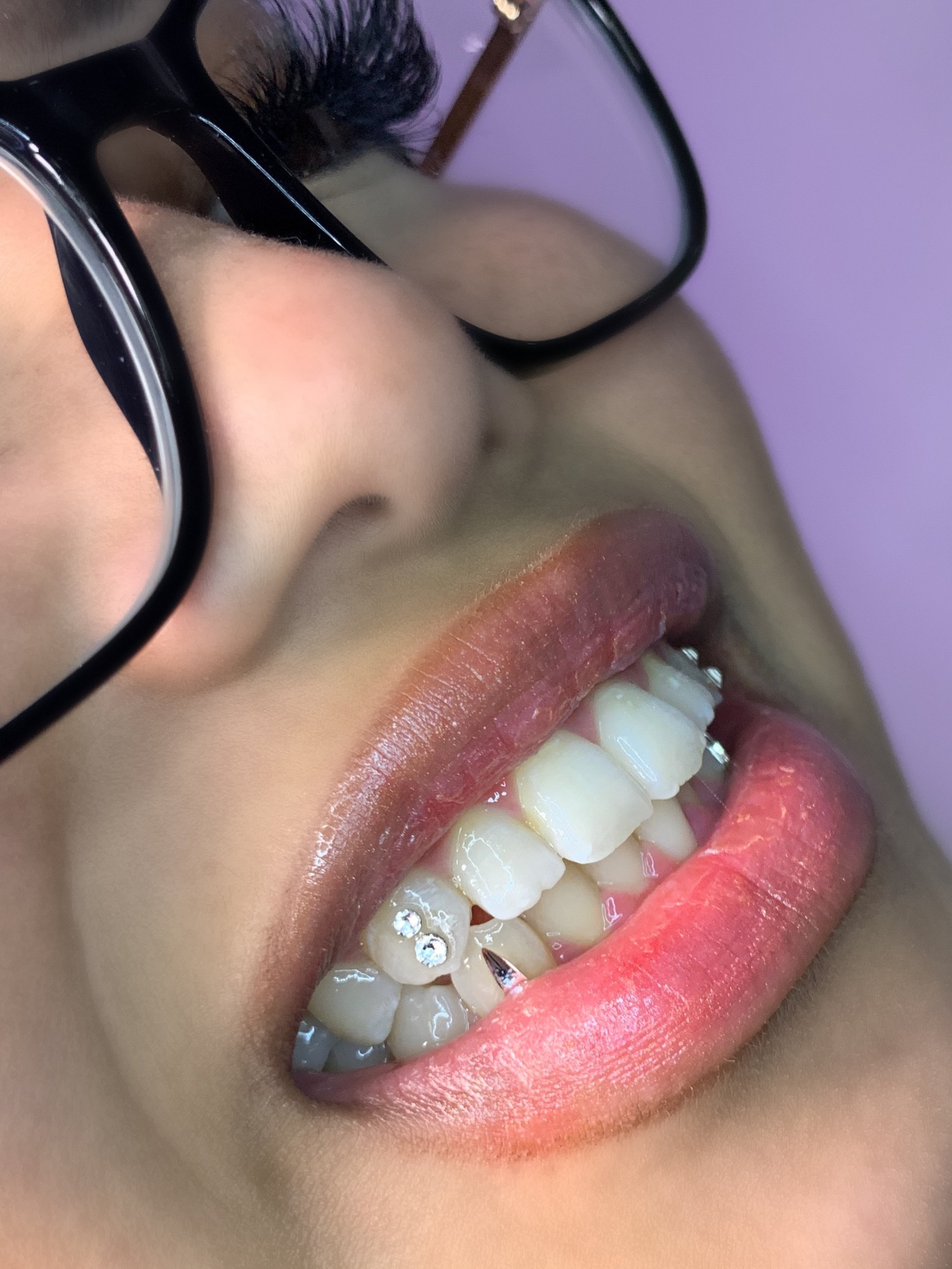 Nhi performing tooth gem application